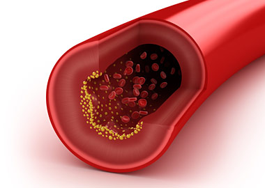 Как снизить холестерин в крови